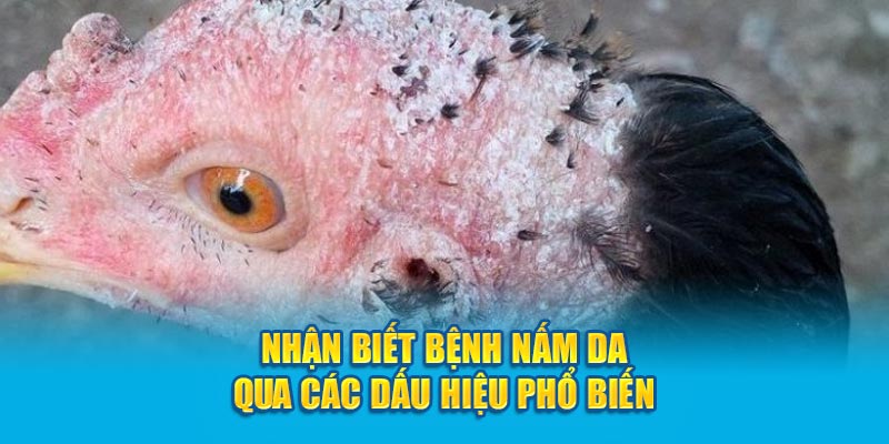 Nhận biết bệnh nấm da qua các dấu hiệu phổ biến